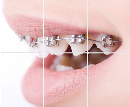 Conventional Metal Braces
